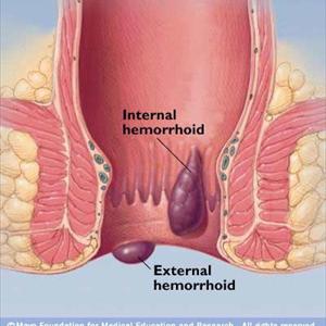Hemroids And Pregnancy - Hemorrhoids Treatments - Home And Surgery