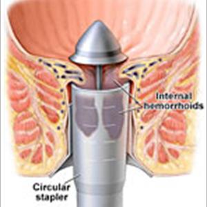 Hemroid Photos - Kinds Of Hemorrhoid Remedy