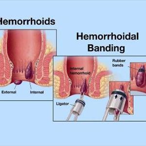 Tucks Hemorrhoid - Hemorrhoids Home Remedy - A Sure Cure For Relieving Your Hemorrhoid Suffering