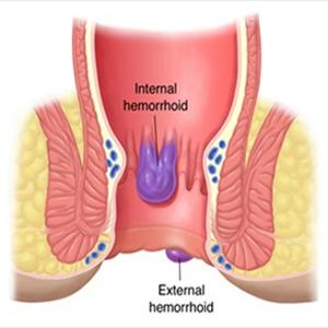 How Long Hemroids Last - I Cured My Hemorrhoids - Fast And Natural Hemorrhoid Relief