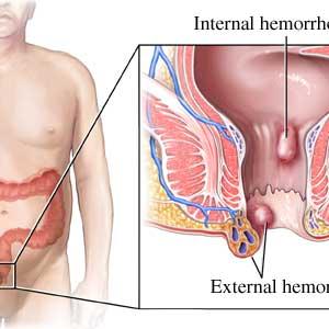Cure A Hemroid - Natural Hemorrhoid Treatment Vs Pharmaceutical Hemorrhoid Treatment