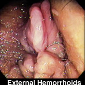 Hemroid Cure - Hemorrhoid Ligation - Symptoms Of Internal Hemorrhoids - External Hemroids Treatment