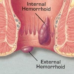 Hemorrhoid Surgery Options - Hemorrhoid Miracle(H Miracle) Review - Hemorrhoid Miracle Scam