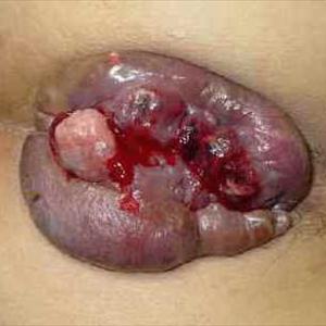 Picture Of Hemorrhoid - Do All Hemorrhoid Treatments Give Results?