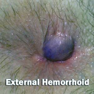 Hemorrhoid Relief Center Columbus - How To Cure A Thrombosed External Hemorrhoid - 5 Treatments That Provide Fast Relief